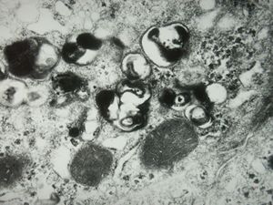 M,8y. | Wilson disease susp. M,8y. | Wilson disease susp.